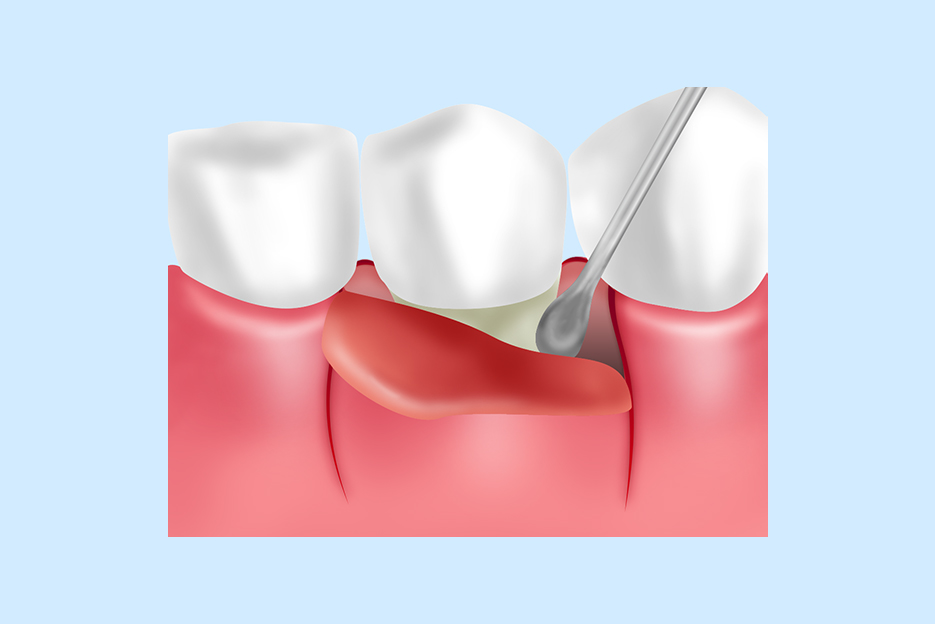 重度の歯周病：歯周外科治療